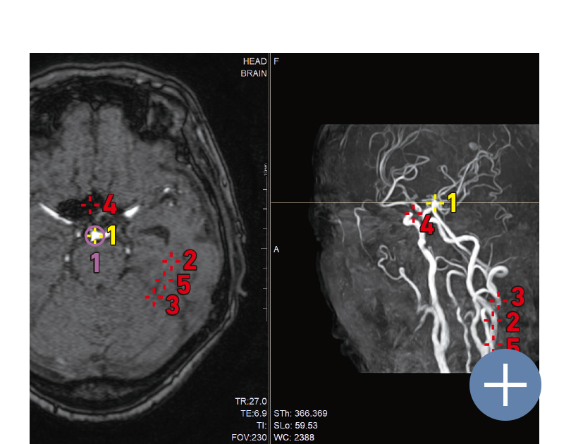 頭部ＭＲＡ画像に対する脳動脈瘤検出支援AI EIRL aneurysm